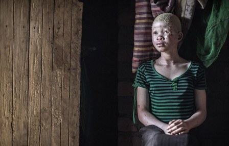 Di Afrika, Orang Albino Diburu untuk Ritual Sihir